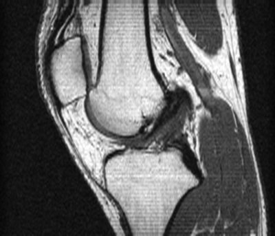 MRI slice showing the knee joint