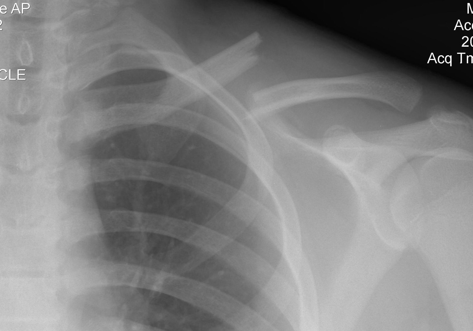 Clavicle radiograph