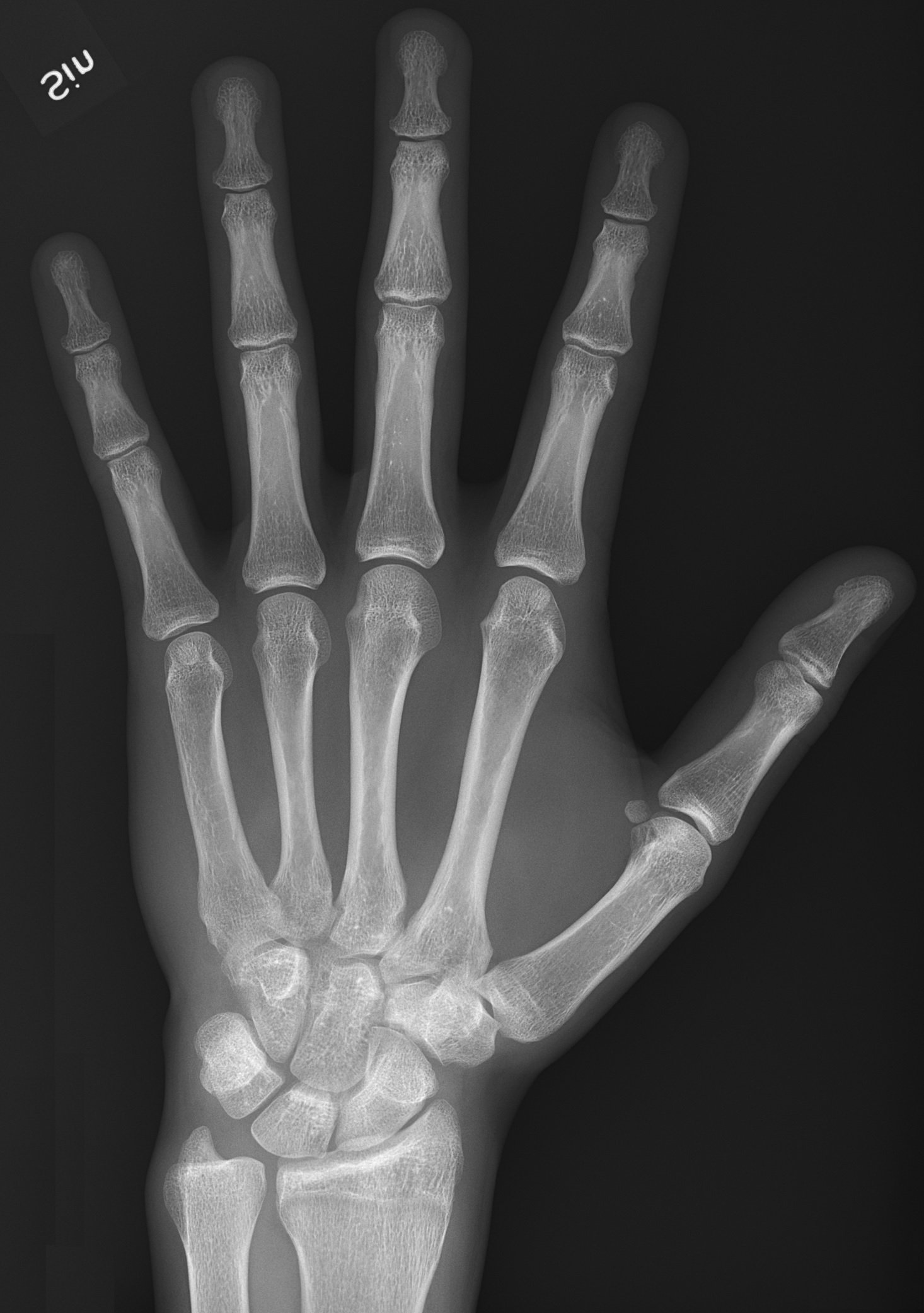 Radiograph of the left hand