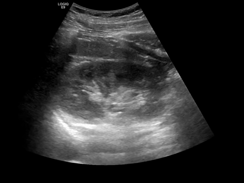 Ultrasound image of the left kidney